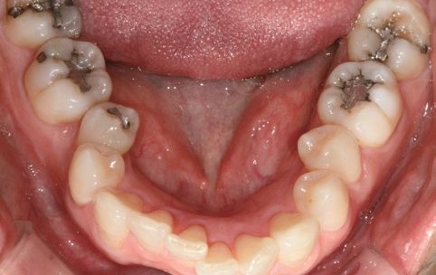 Zircos-Com Flow before clinical result